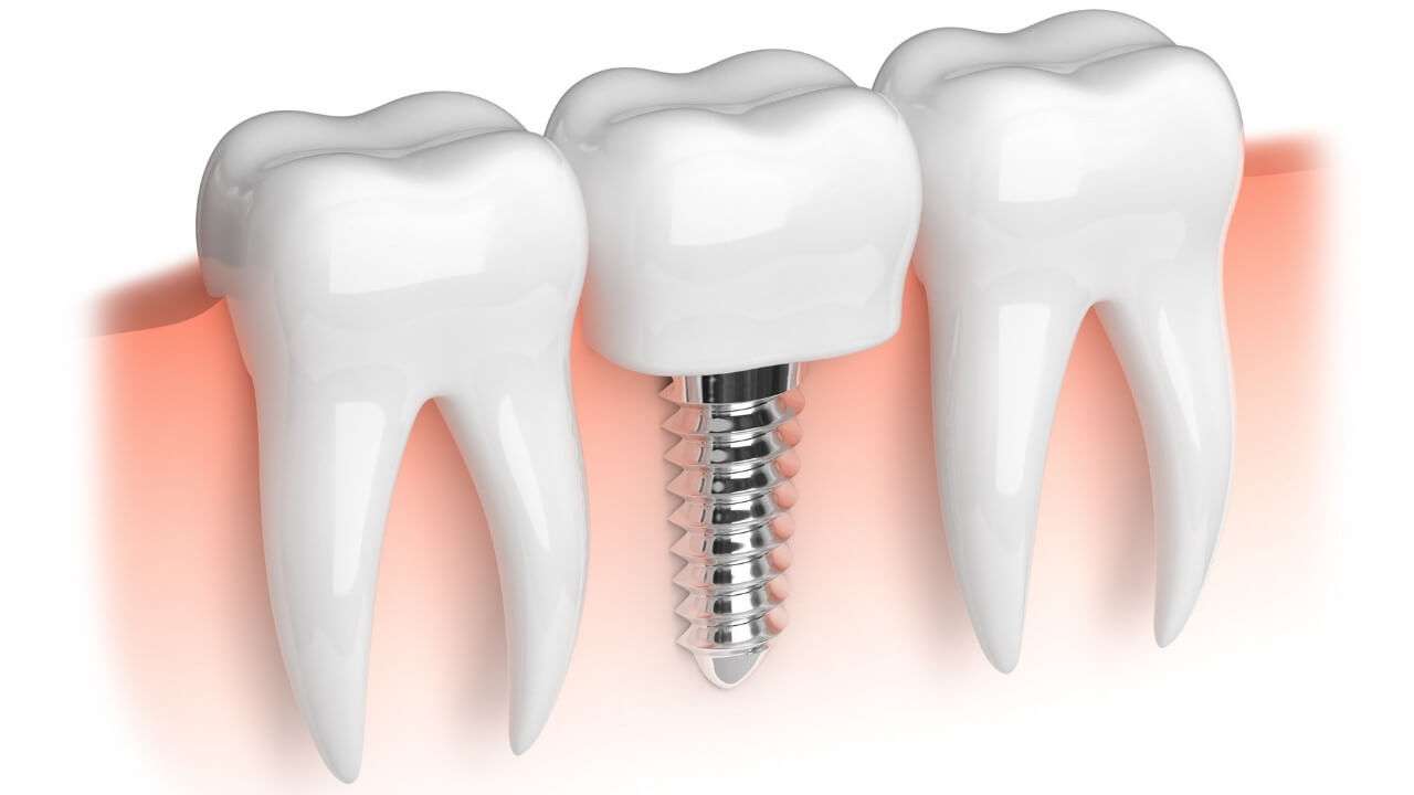 osteointegrazione impianti dentali