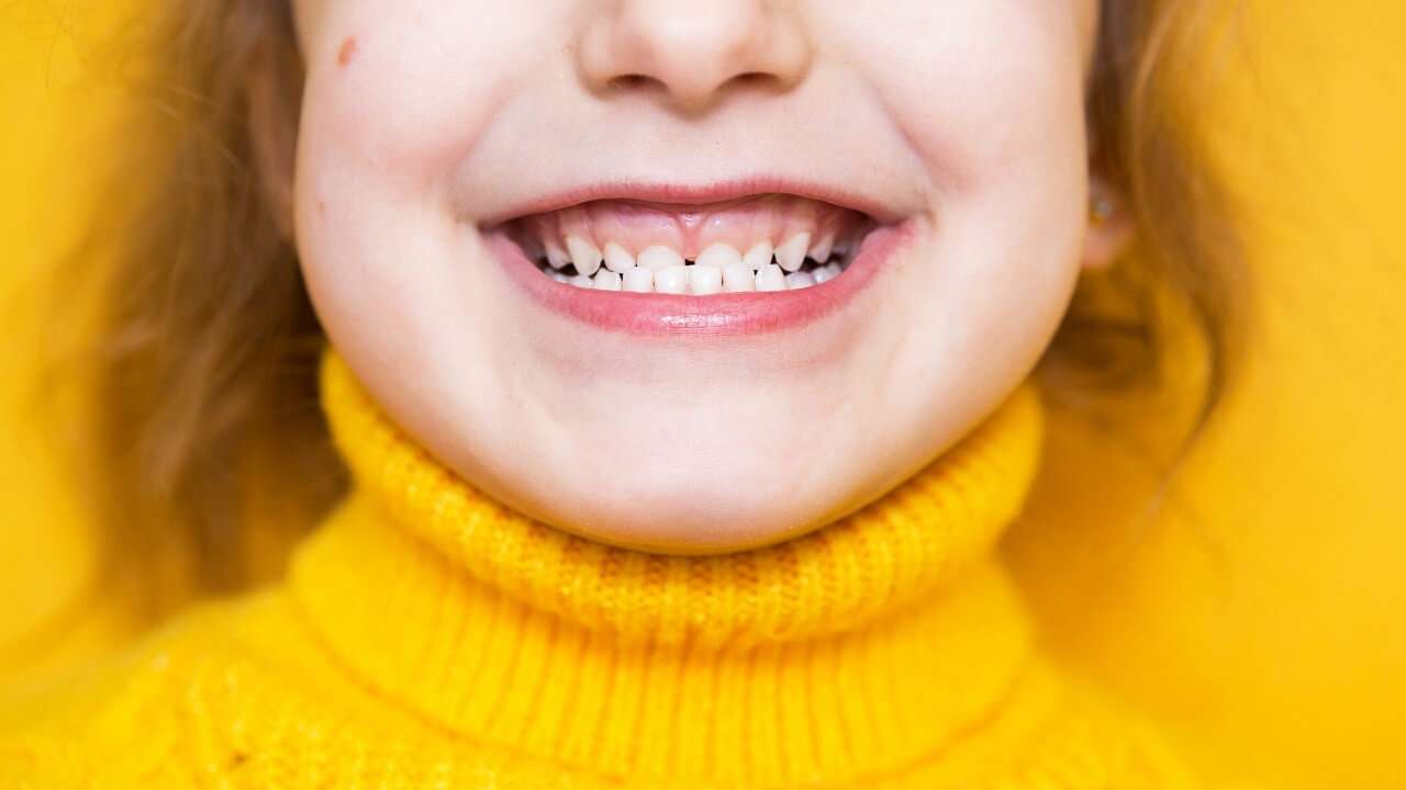 malocclusione dentale nei bambini