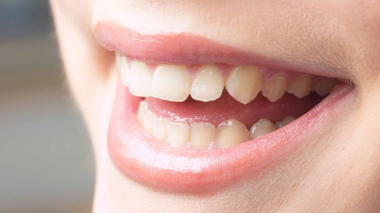 denti trasparenti cause e rimedi