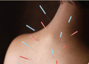 per quali patologie è indicata l'agopuntura?