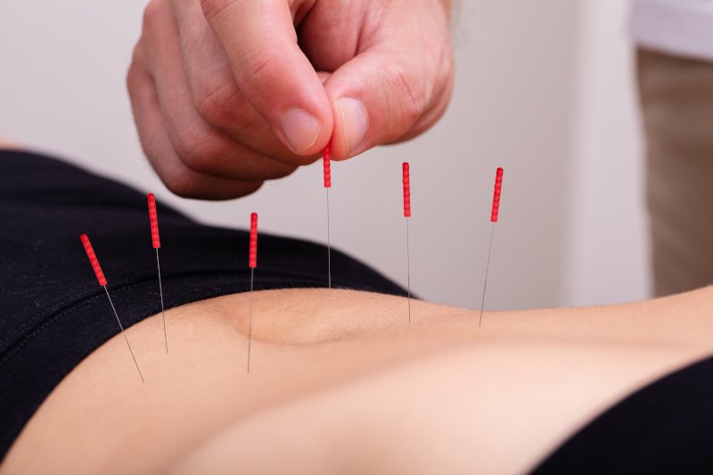 l'agopuntura può essere una cura risolutiva
