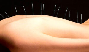 A chi è sconsigliata l'agopuntura?