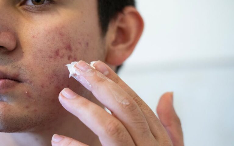 acne giovanile: trattamento