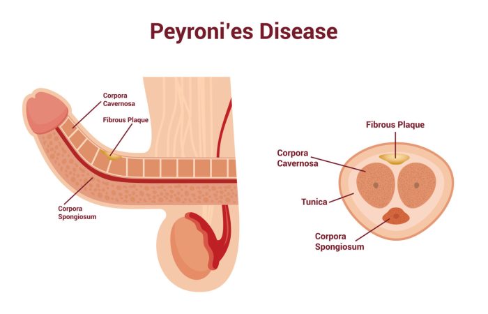 Malattia di Peyronie