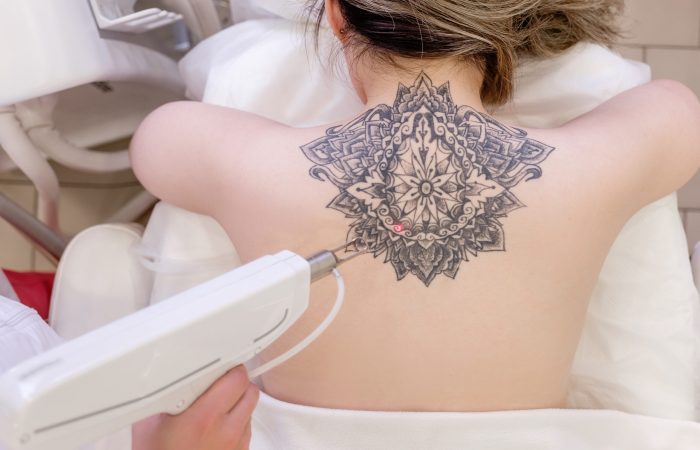 Rimozione del Tatuaggio con il Laser