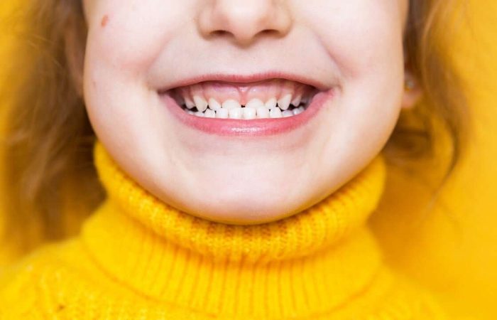 malocclusione dentale nei bambini