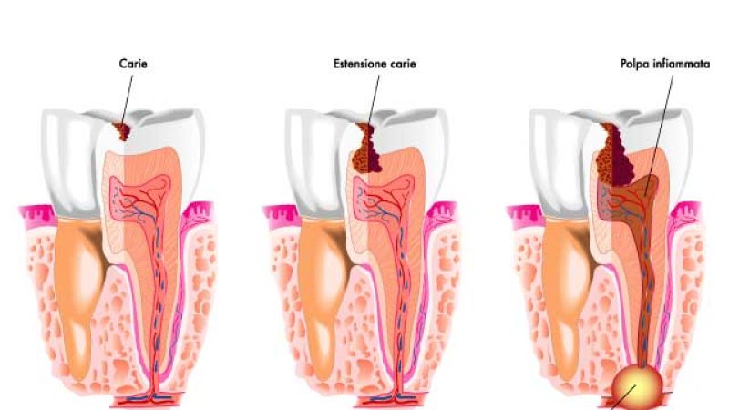 pulpite-dentale