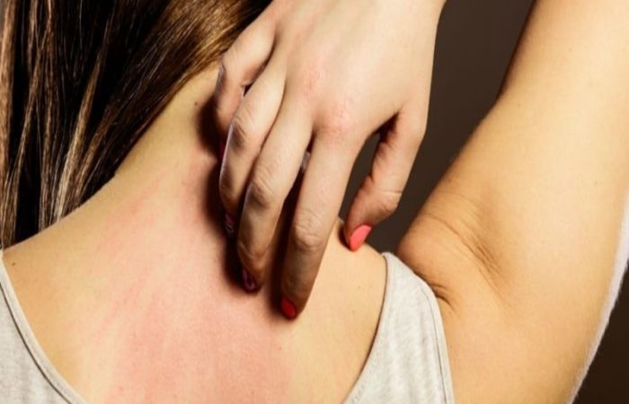 rimedi contro l orticaria